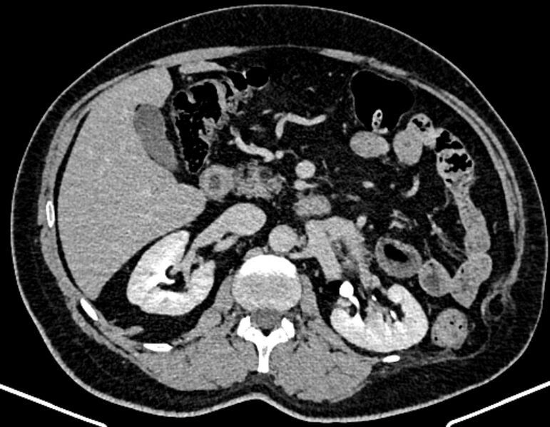 File:Adrenal metastases (Radiopaedia 73082-83791 Axial C+ delayed 131).jpg