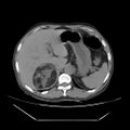 Adrenal myelolipoma (Radiopaedia 41843-44834 Axial non-contrast 14).jpg