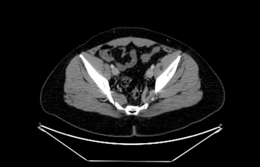 Adrenocortical carcinoma (Radiopaedia 80134-93438 Axial C+ portal venous phase 111).jpg