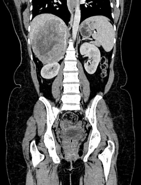 File:Adrenocortical carcinoma (Radiopaedia 87281-103569 Coronal C+ portal venous phase 78).jpg