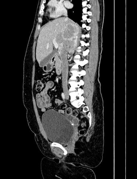 File:Adrenocortical carcinoma (Radiopaedia 87281-103569 Sagittal C+ portal venous phase 125).jpg