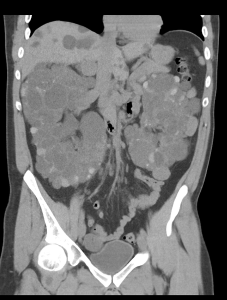 File:Adult polycystic kidney disease (Radiopaedia 47866-52626 Coronal non-contrast 21).png