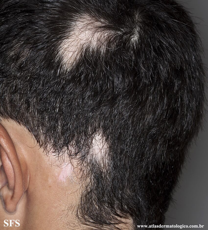 Alopecia Areata And Vitiligo (Dermatology Atlas 5).jpg