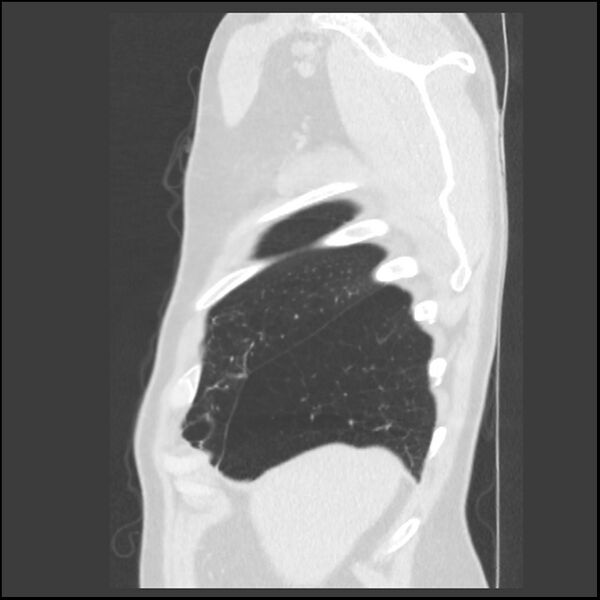 File:Alpha-1-antitrypsin deficiency (Radiopaedia 40993-43722 Sagittal lung window 243).jpg