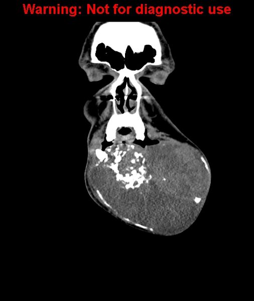 File:Ameloblastoma (Radiopaedia 33126-34164 D 14).jpg