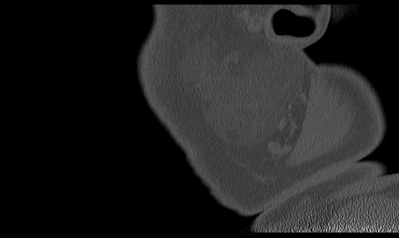 File:Ameloblastoma (Radiopaedia 33677-34806 Sagittal bone window 58).png