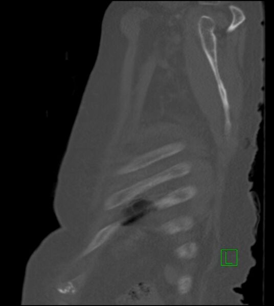 File:Amiodarone deposition in the liver (Radiopaedia 77587-89780 Sagittal bone window 16).jpg