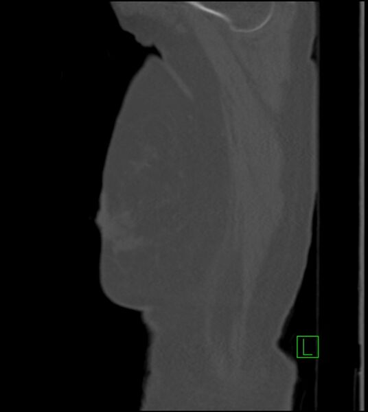 File:Amiodarone deposition in the liver (Radiopaedia 77587-89780 Sagittal bone window 94).jpg
