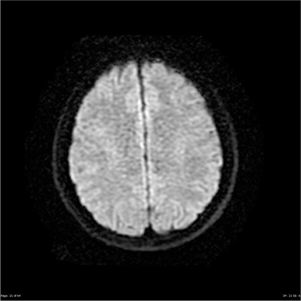 File:Amnestic syndrome secondary to hypoxic brain injury (Radiopaedia 24743-25004 DWI 21).jpg