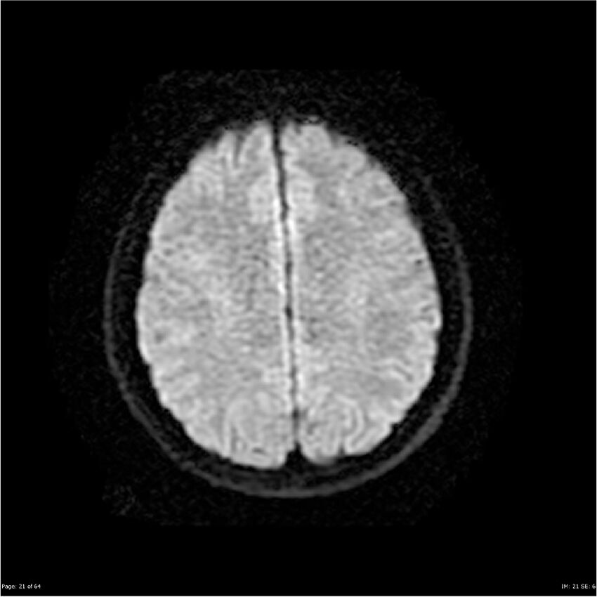 Amnestic syndrome secondary to hypoxic brain injury (Radiopaedia 24743-25004 DWI 21).jpg