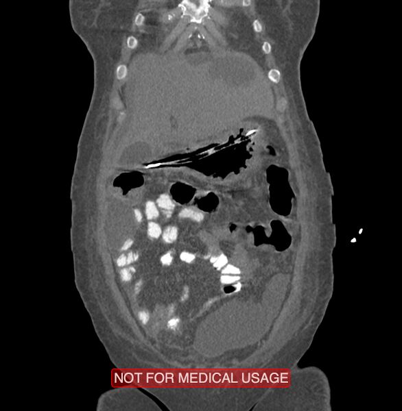 File:Amoebic enterocolitis with liver abscess (Radiopaedia 35100-36609 B 25).jpg