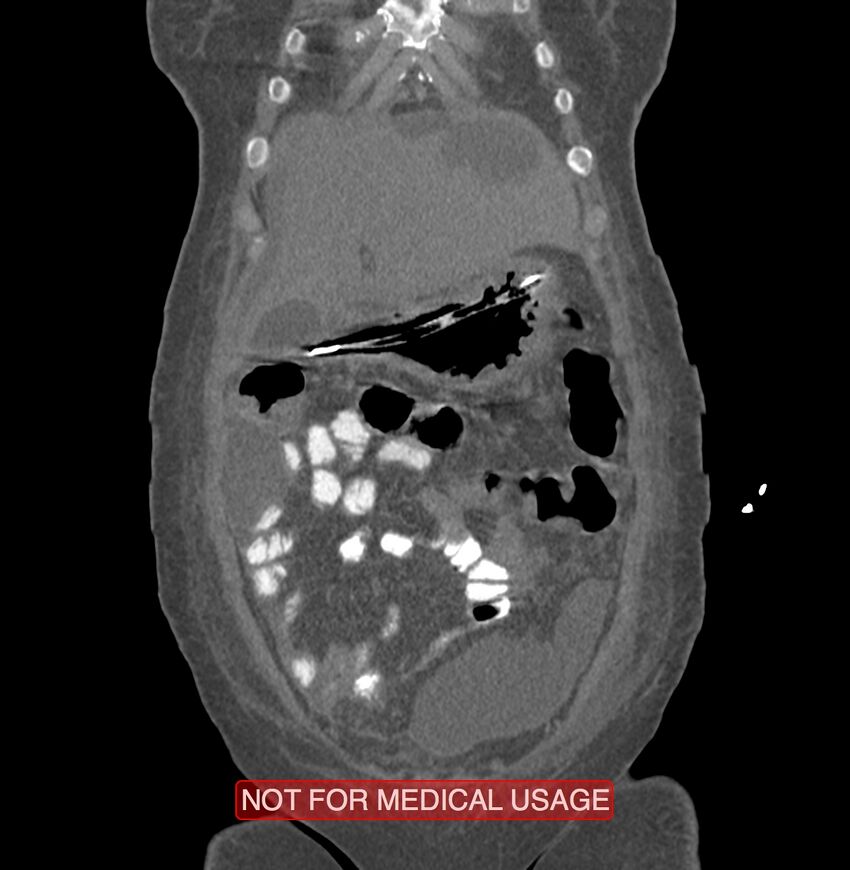 Amoebic enterocolitis with liver abscess (Radiopaedia 35100-36609 B 25).jpg