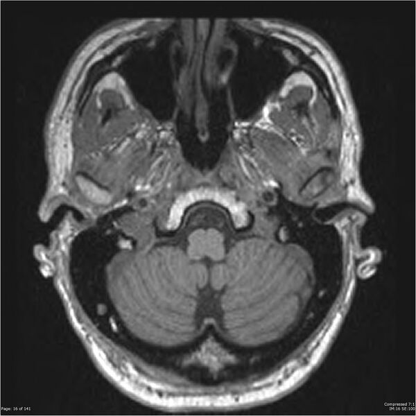 File:Anaplastic meningioma with recurrence (Radiopaedia 34452-35788 Axial T1 14).jpg