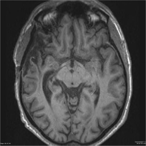 File:Anaplastic meningioma with recurrence (Radiopaedia 34452-35788 Axial T1 58).jpg