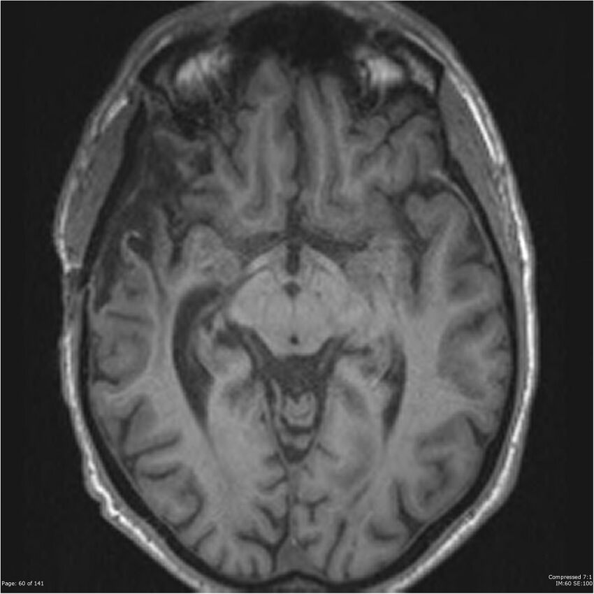 Anaplastic meningioma with recurrence (Radiopaedia 34452-35788 Axial T1 58).jpg