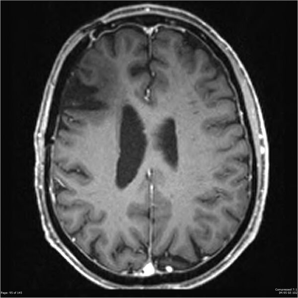 File:Anaplastic meningioma with recurrence (Radiopaedia 34452-35788 Axial T1 C+ 95).jpg