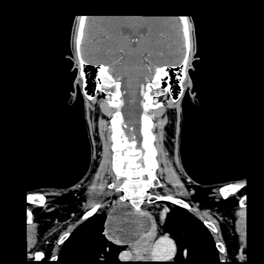 Anaplastic thyroid carcinoma (Radiopaedia 79087-92034 A 78).jpg