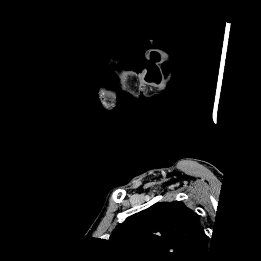 Anaplastic thyroid carcinoma (Radiopaedia 79087-92034 C 84).jpg