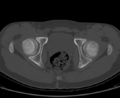 Aneurysmal bone cyst of ischium (Radiopaedia 25957-26094 Axial bone window 59).png