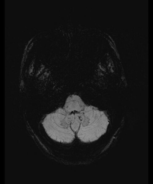 File:Angiomatous meningioma (Radiopaedia 79459-92579 E 8).jpg