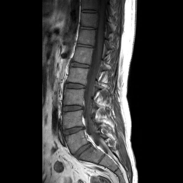 File:Ankylosing spondylitis with zygapophyseal arthritis (Radiopaedia 38433-40516 Sagittal T1 6).jpg