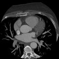 Anomalous origin of left circumflex artery from right coronary sinus (Radiopaedia 72563-83117 A 42).jpg