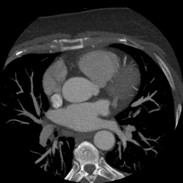 File:Anomalous origin of left circumflex artery from right coronary sinus (Radiopaedia 72563-83117 A 42).jpg