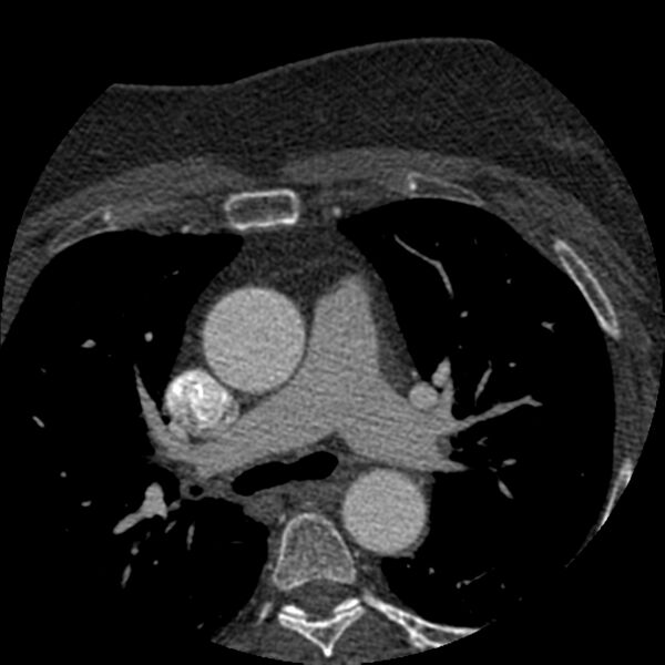 File:Anomalous origin of left circumflex artery from right coronary sinus (Radiopaedia 72563-83117 B 1).jpg