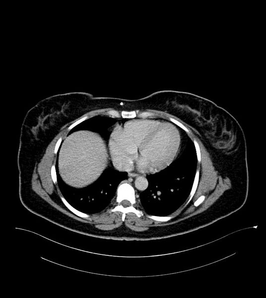 File:Anterior abdominal wall CSF pseudocyst (CSFoma) (Radiopaedia 79453-92571 A 10).jpg