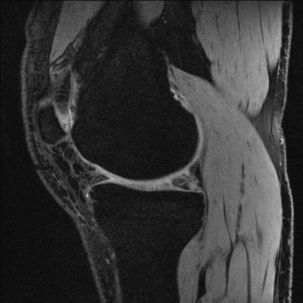 File:Anterior cruciate ligament mucoid degeneration (Radiopaedia 68400-77933 Sagittal 43).jpg