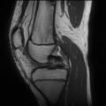 Anterior cruciate ligament tear - pediatric (Radiopaedia 62152-70260 Sagittal PD 73).jpg