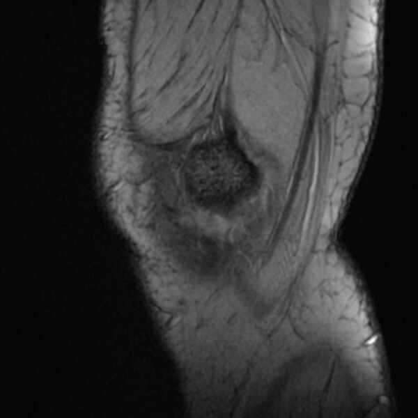 File:Anterior cruciate ligament tear - ramp lesion (Radiopaedia 71883-82322 Sagittal T2 fat sat 23).jpg