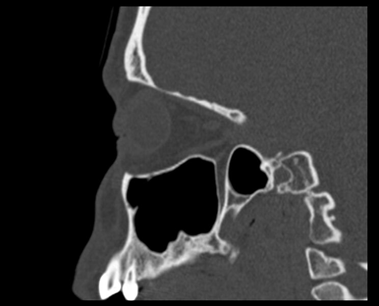 File:Antrochoanal polyp (Radiopaedia 21894-21868 Sagittal bone window 29).jpg
