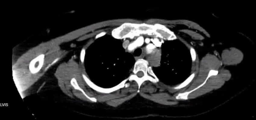 Aortic Dissection (Radiopaedia 85272-100847 A 10).jpg