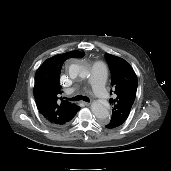 File:Aortic arch graft infection (FDG PET-CT) (Radiopaedia 71975-82437 A 21).jpg