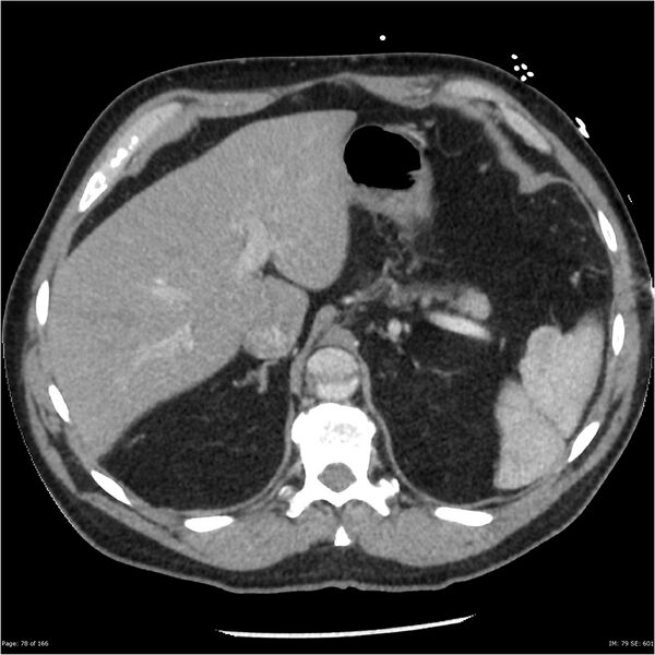File:Aortic dissection- Stanford A (Radiopaedia 37759-39664 A 69).jpg