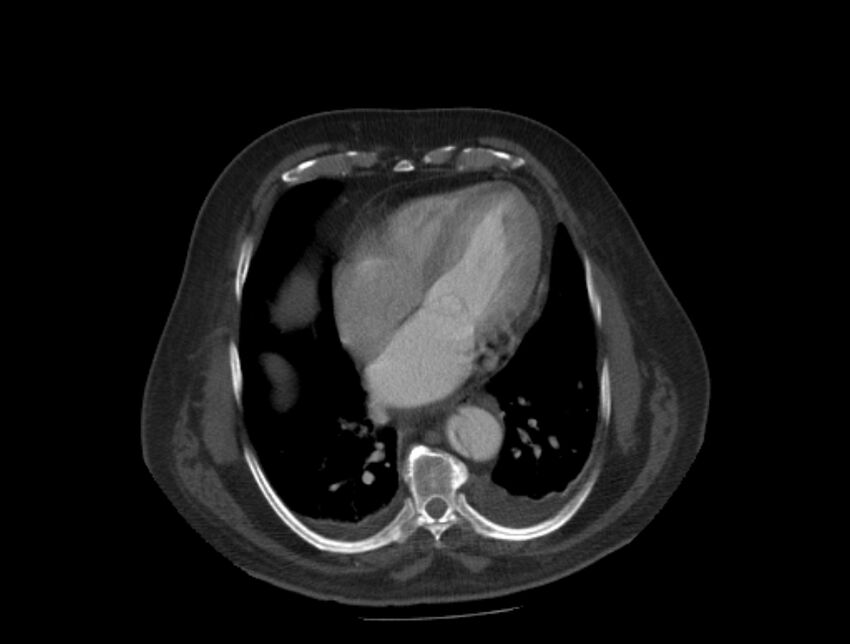Aortic dissection (Radiopaedia 28802-29105 A 28).jpg