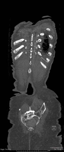 File:Aortic dissection with extension into aortic arch branches (Radiopaedia 64402-73204 A 74).jpg