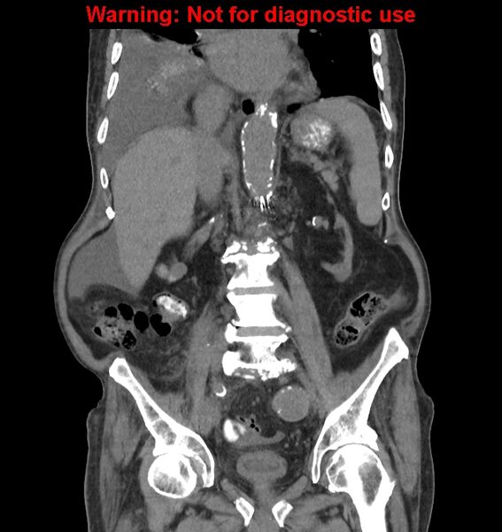 File:Aortic graft infection (Radiopaedia 44979-48907 non-contrast 29).jpg
