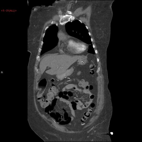File:Aortic intramural hematoma (Radiopaedia 27746-28001 B 6).jpg