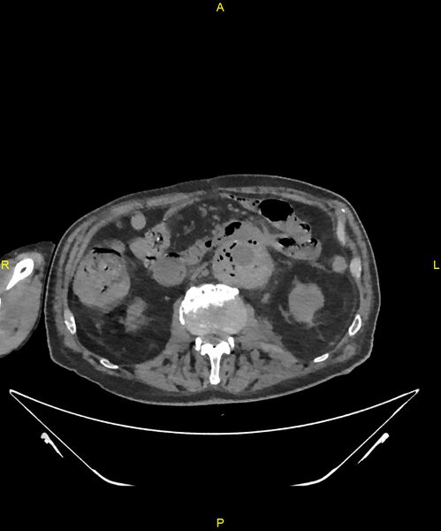 File:Aortoenteric fistula (Radiopaedia 84308-99603 Axial non-contrast 159).jpg