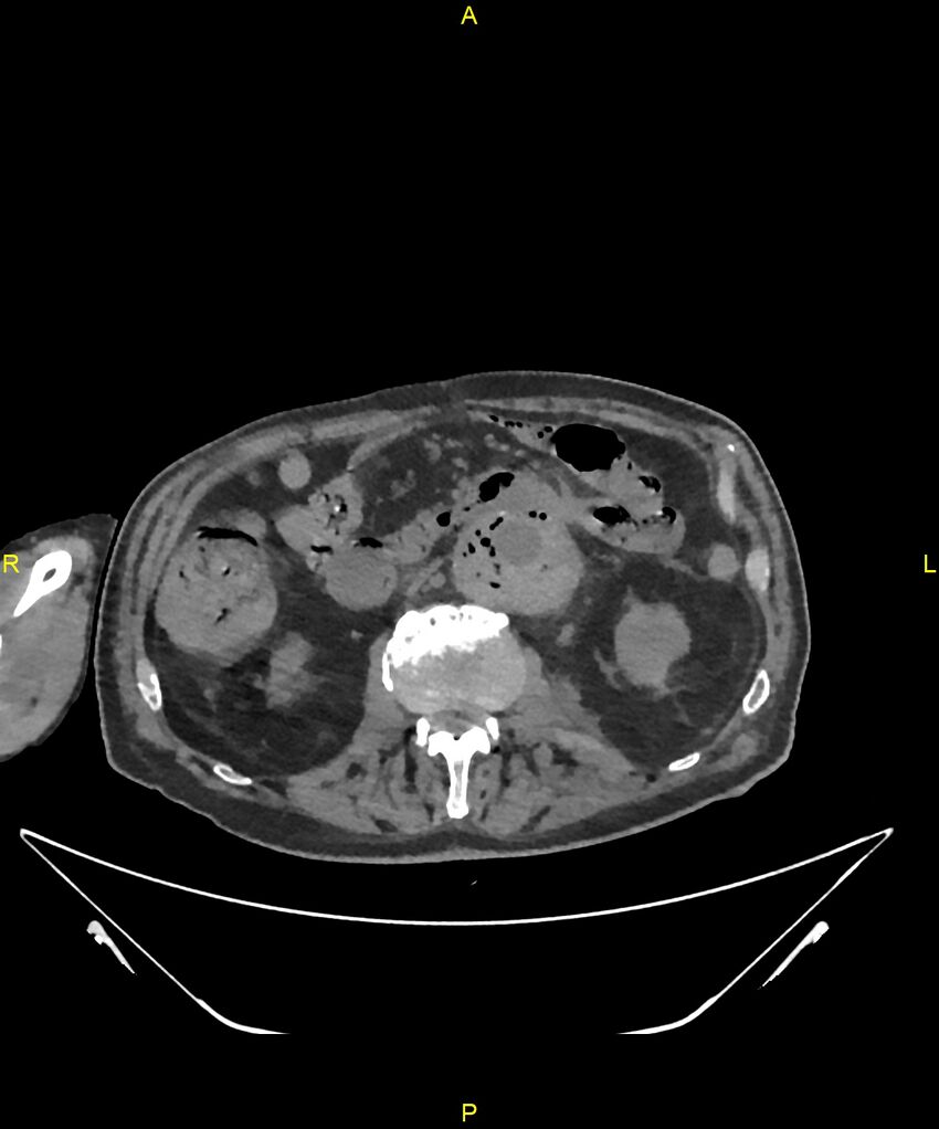 Aortoenteric fistula (Radiopaedia 84308-99603 Axial non-contrast 159).jpg