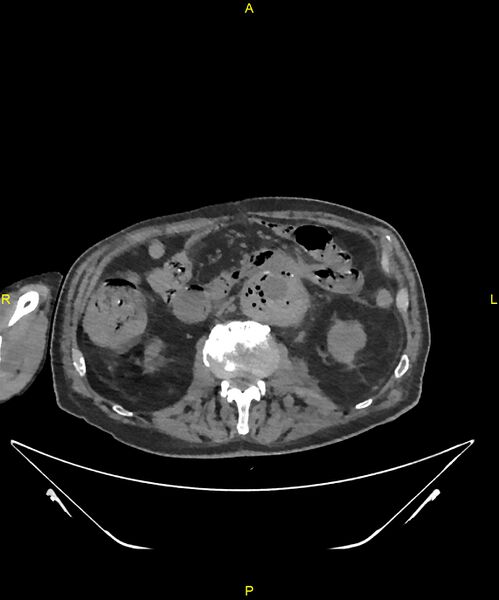 File:Aortoenteric fistula (Radiopaedia 84308-99603 Axial non-contrast 160).jpg