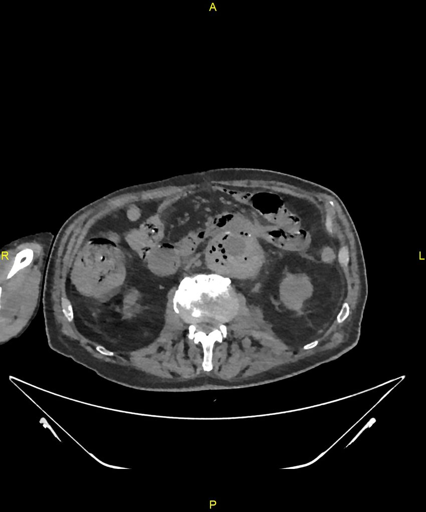 Aortoenteric fistula (Radiopaedia 84308-99603 Axial non-contrast 160).jpg