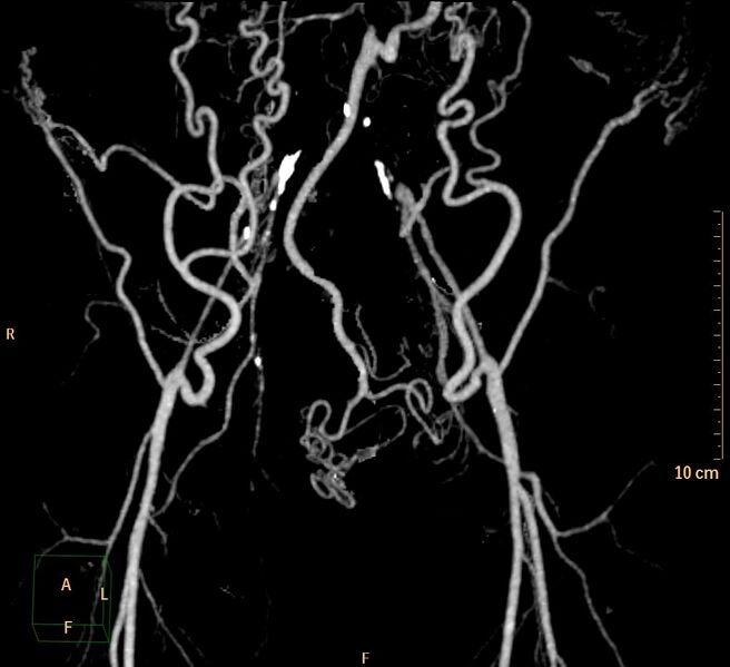 File:Aortoiliac occlusive disease (Radiopaedia 31376-32161 3D-VR-iliac arteries 3).jpg