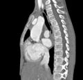 Aortopulmonary window, interrupted aortic arch and large PDA giving the descending aorta (Radiopaedia 35573-37074 C 11).jpg
