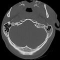 Apical pneumothorax on cervical spine CT (Radiopaedia 45343-49368 Axial bone window 3).jpg