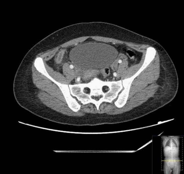 File:Appendicitis (CT angiogram) (Radiopaedia 154713-127660 Axial 2).jpg