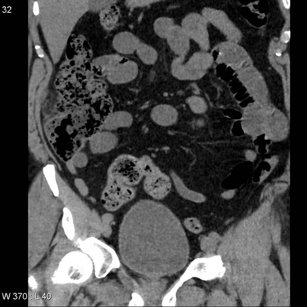 File:Appendicitis (Radiopaedia 12510-12733 Coronal non-contrast 2).jpg
