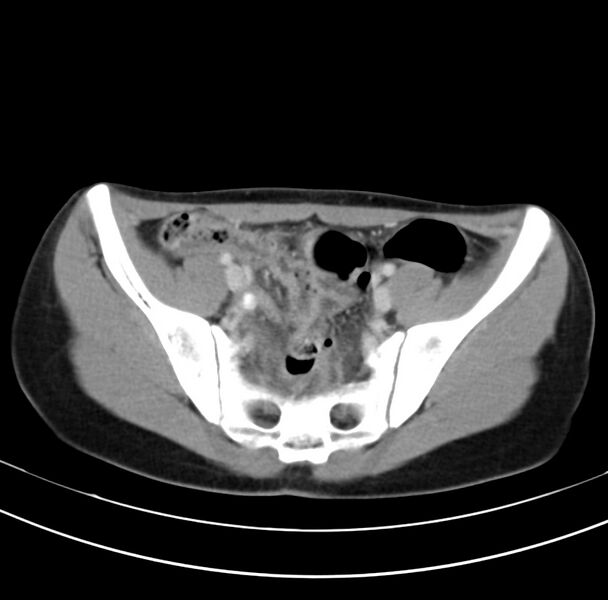 File:Appendicitis and incidental bicornuate uterus (Radiopaedia 22833-22853 B 36).jpg